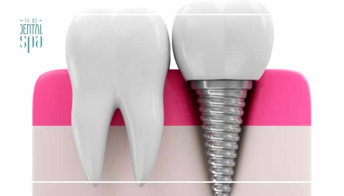 Periimplantitis sintomas