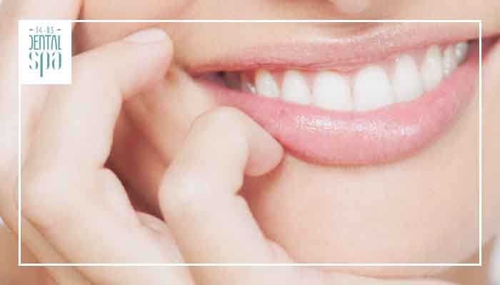 frecuencia blanqueamiento dental
