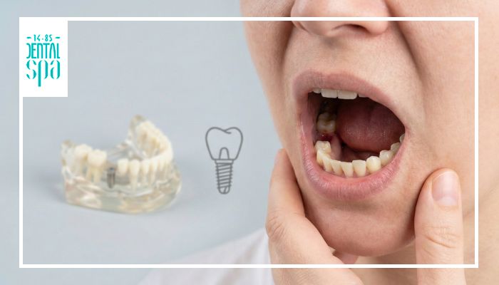 Consecuencias de la ausencia dental en masticacion y alineacion