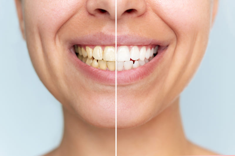 Blanqueamiento dental antes de un evento especial, cuánto dura, cuándo hacerlo y qué esperar realmente