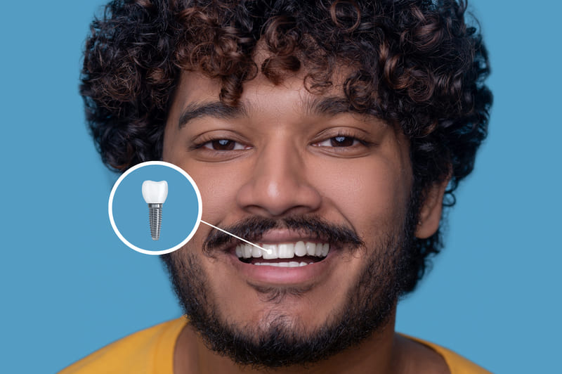 Guía para saber si eres candidato a implantes dentales