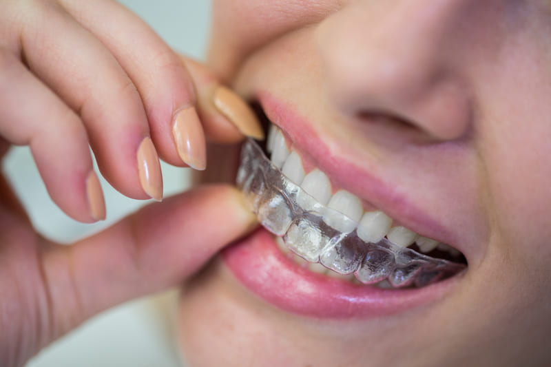 ¿Qué es la regla de los 30 minutos en Invisalign?