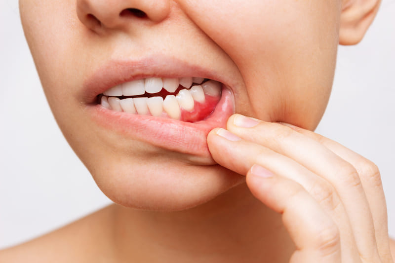 ¿Encías inflamadas? Conoce sus causas, síntomas y tratamientos para aliviar la inflamación y prevenir la gingivitis y la periodontitis a tiempo.