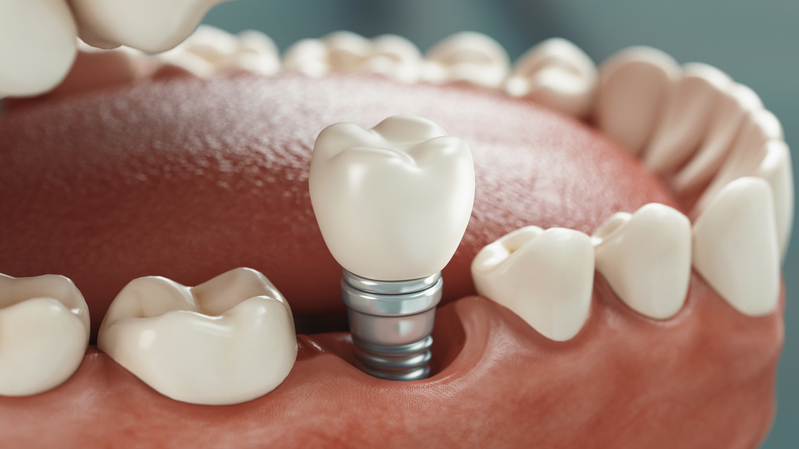 ¿Qué pasa si no tengo suficiente hueso para un implante dental?