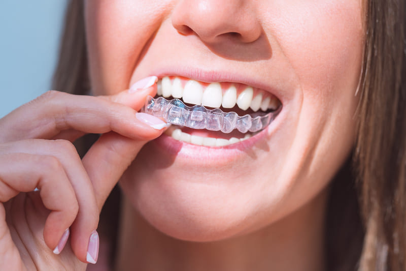 Invisalign para adolescentes: descubre sus ventajas, cómo funciona y qué cuidados requiere para corregir la sonrisa de forma discreta y cómoda.