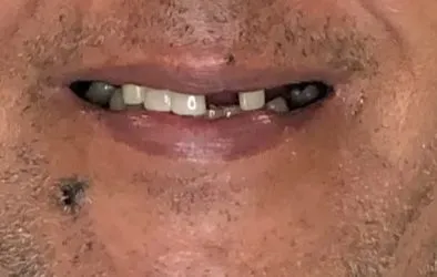 Paciente con implantes dentales en caso clínico