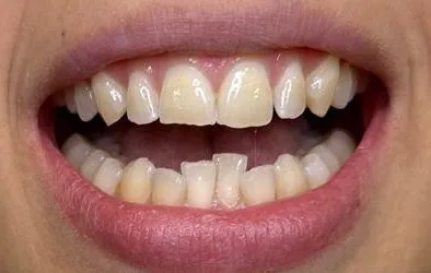 Sonrisa de paciente después de tratamiento con implantes dentales