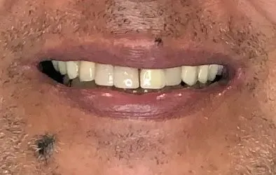 Resultado de tratamiento con implantes dentales