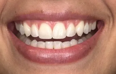 Sonrisa de paciente tras tratamiento de implantes dentales
