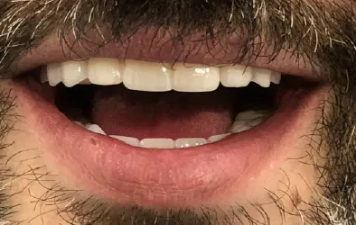 Resultados tratamiento de implantes dentales