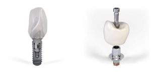 Implantes dentales metalicos
