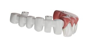protesis-hidrida-dental-digital
